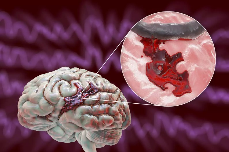 Brain Hemorrhage Symptoms
